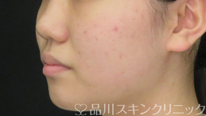症例NO.71469のAFTER写真