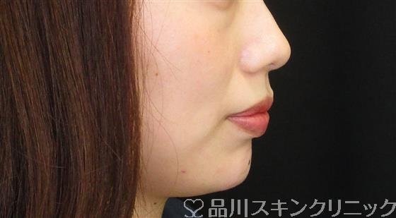 症例NO.61933のAFTER写真