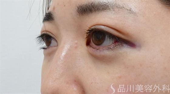 症例NO.50762のAFTER写真