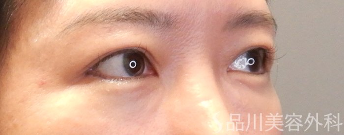 症例NO.67862のAFTER写真