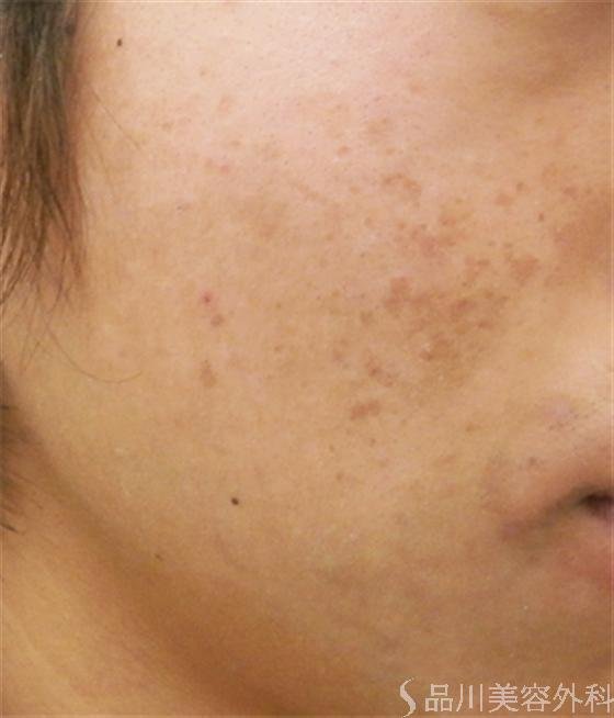 症例NO.18188のBEFORE写真