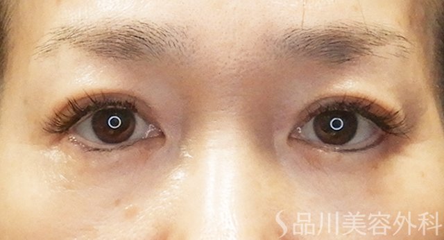 症例NO.65457のAFTER写真