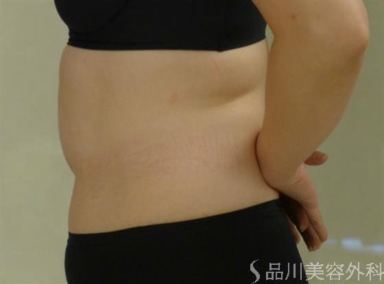 症例NO.41032のAFTER写真