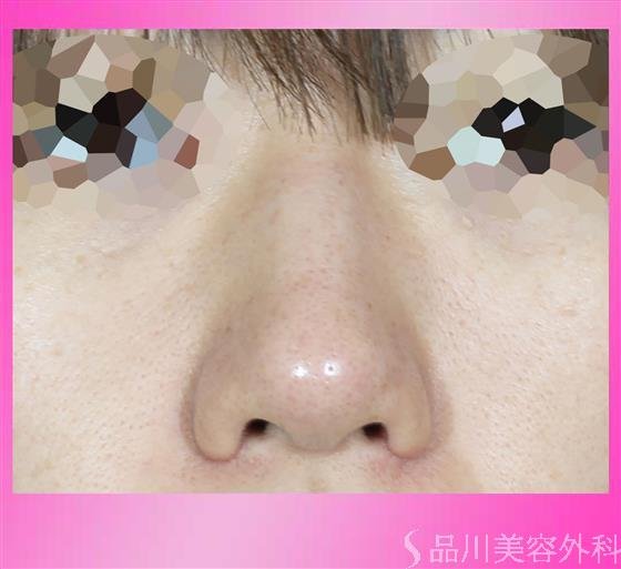 症例NO.54279のAFTER写真