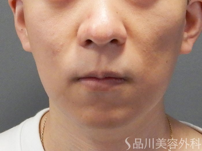 症例NO.73628のBEFORE写真