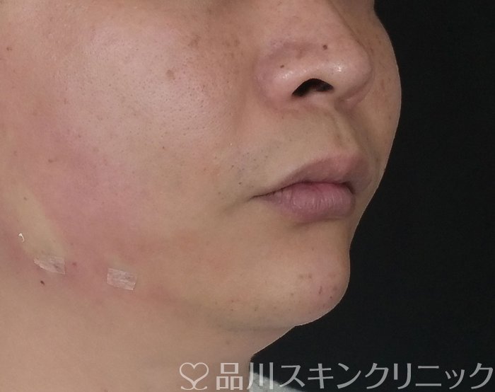症例NO.70031のAFTER写真