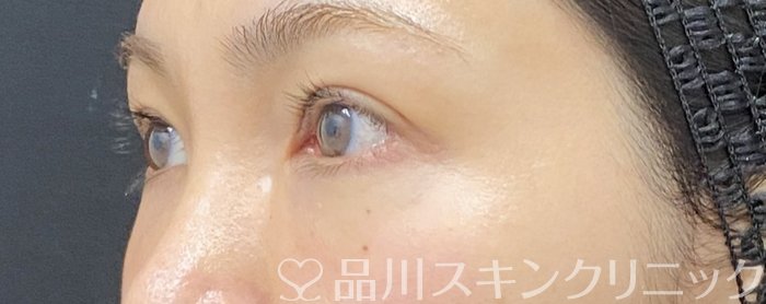 症例NO.75164のAFTER写真
