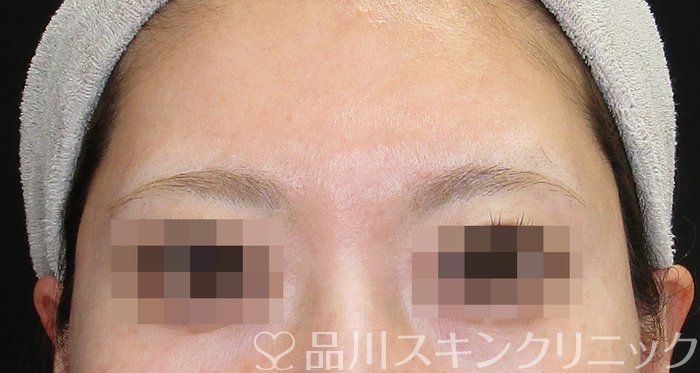 症例NO.74118のAFTER写真