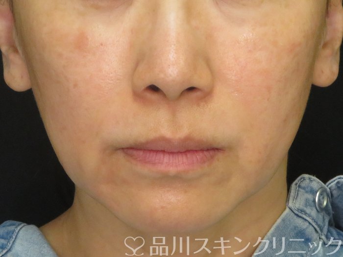 症例NO.70136のBEFORE写真