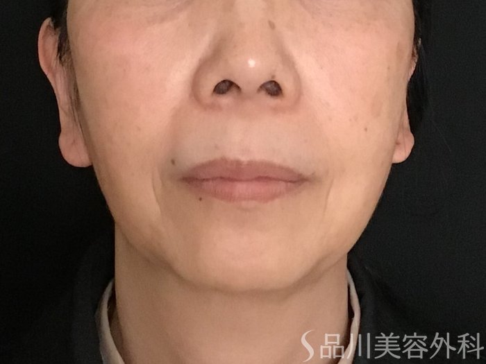 症例NO.65353のBEFORE写真