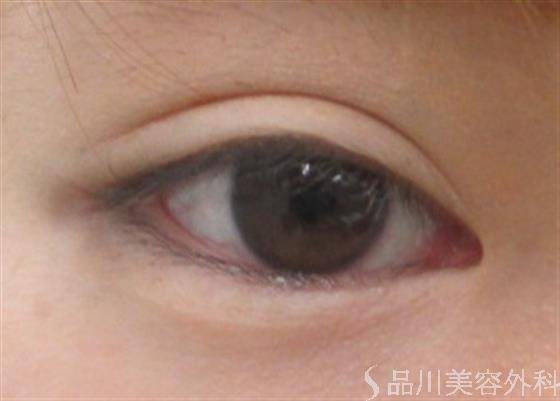 症例NO.23523のBEFORE写真