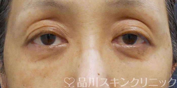 症例NO.75328のAFTER写真