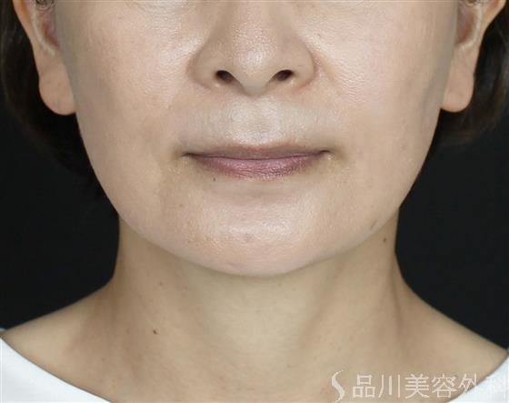 症例NO.61893のAFTER写真