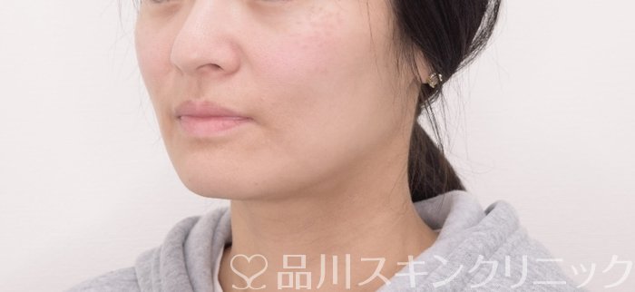 症例NO.69365のAFTER写真
