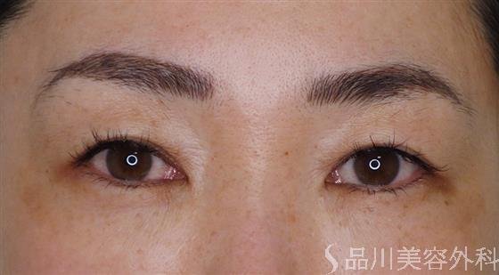 症例NO.51223のBEFORE写真