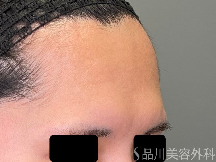 症例NO.71043のBEFORE写真