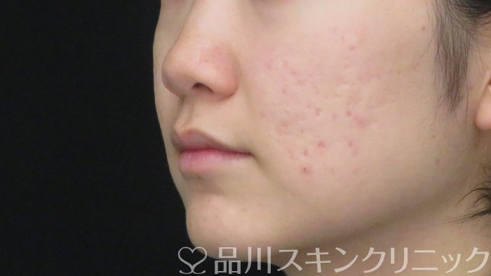 症例NO.72685のBEFORE写真