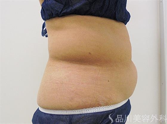 症例NO.22255のBEFORE写真