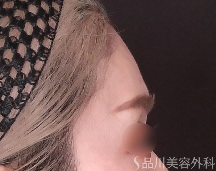 症例NO.69733のBEFORE写真