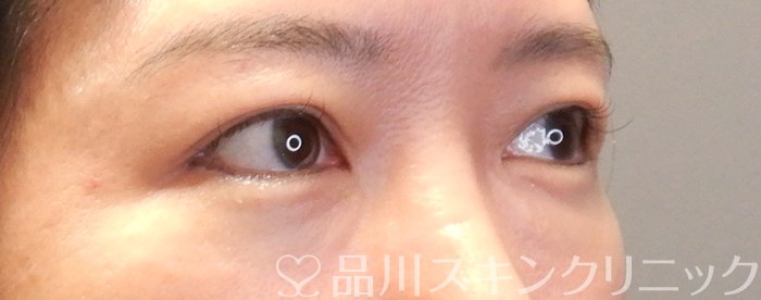 症例NO.67862のAFTER写真