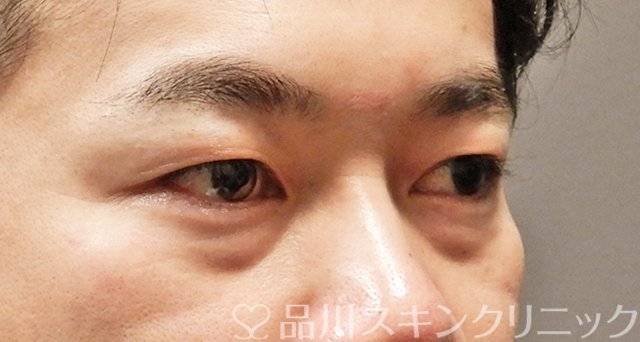 症例NO.67688のBEFORE写真