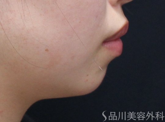 症例NO.73399のBEFORE写真