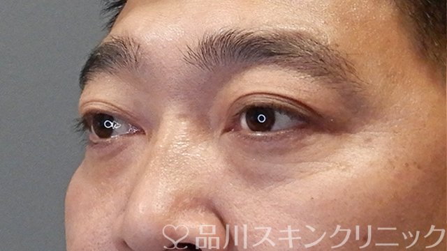 症例NO.65294のAFTER写真