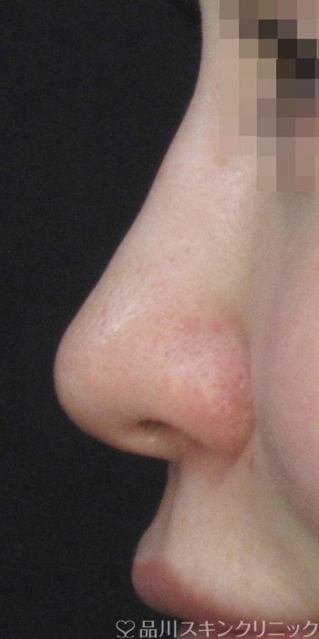 症例NO.72955のAFTER写真