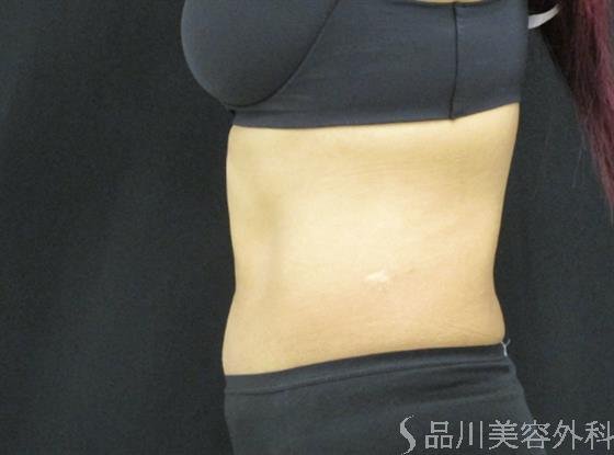 症例NO.47893のAFTER写真
