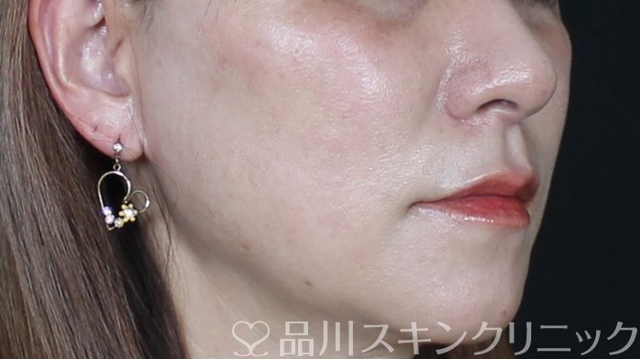 症例NO.71199のAFTER写真