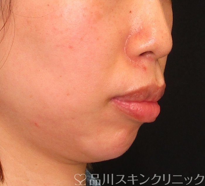 症例NO.69838のBEFORE写真