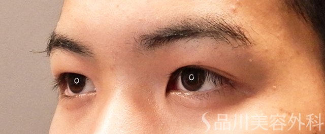 症例NO.71065のBEFORE写真