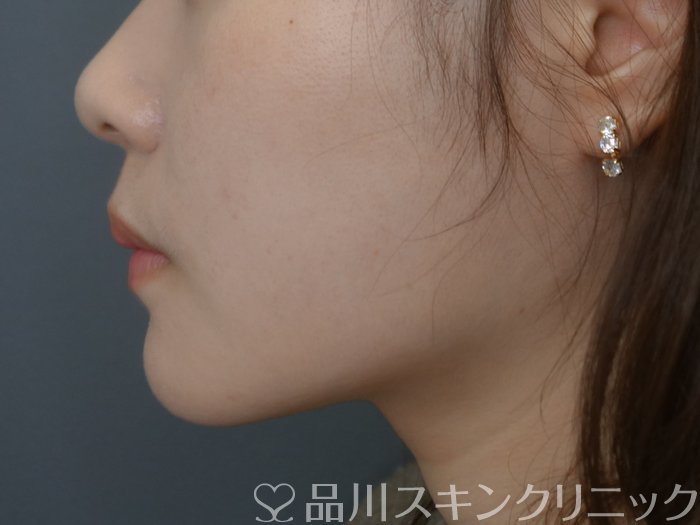 症例NO.73671のAFTER写真