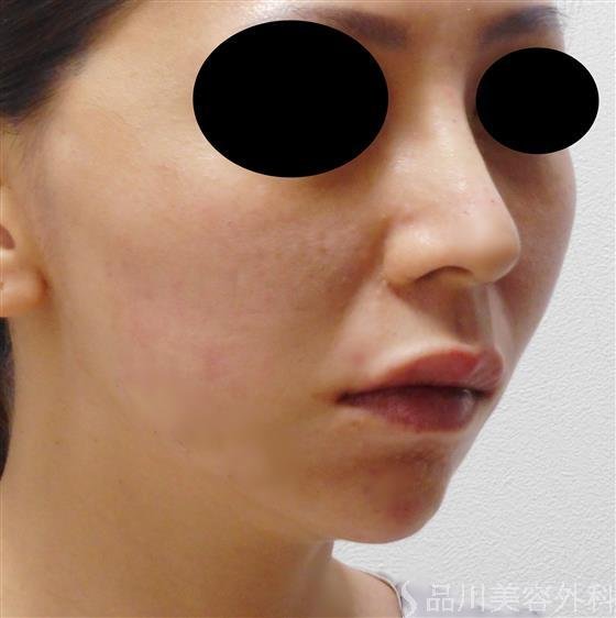 症例NO.35601のAFTER写真