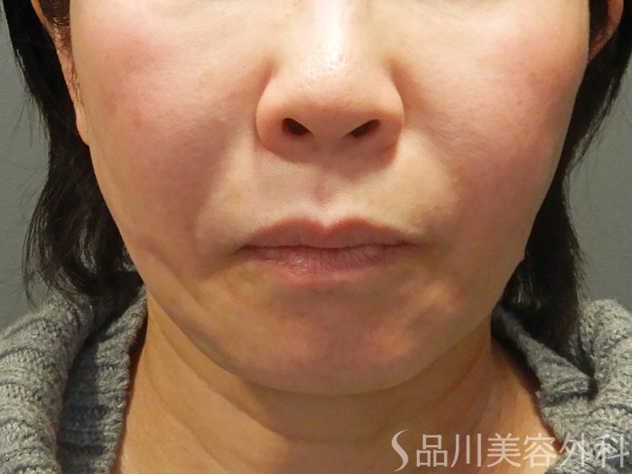 症例NO.69536のAFTER写真