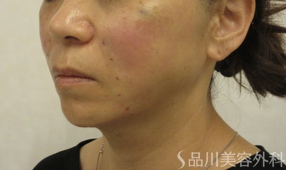 症例NO.72193のAFTER写真