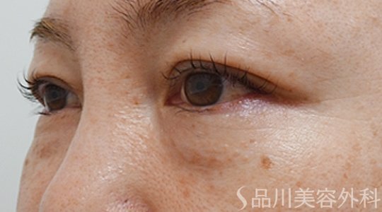 症例NO.74141のBEFORE写真