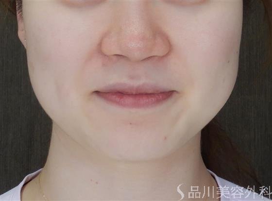 症例NO.59724のBEFORE写真