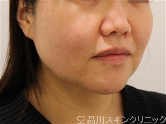 症例NO.44327のBEFORE写真