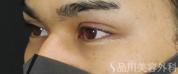 症例NO.72188のAFTER写真