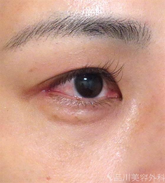 症例NO.27486のAFTER写真