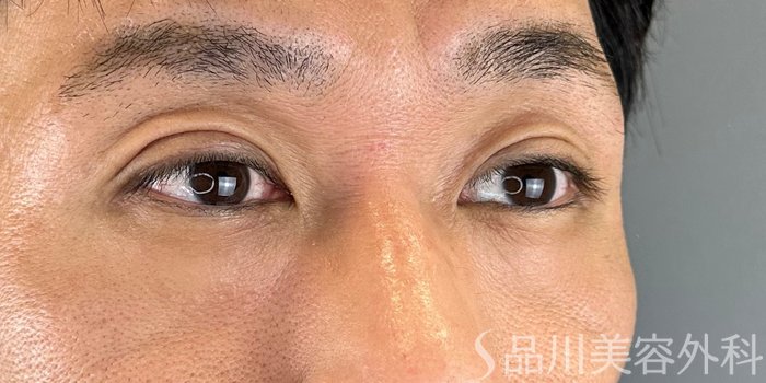 症例NO.70620のAFTER写真
