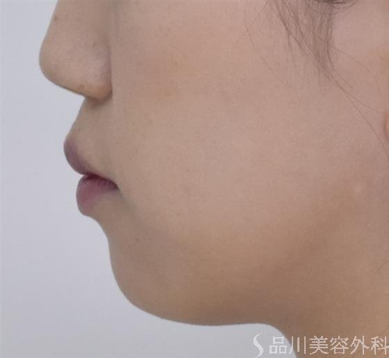 症例NO.49292のBEFORE写真