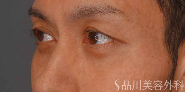 症例NO.74412のBEFORE写真