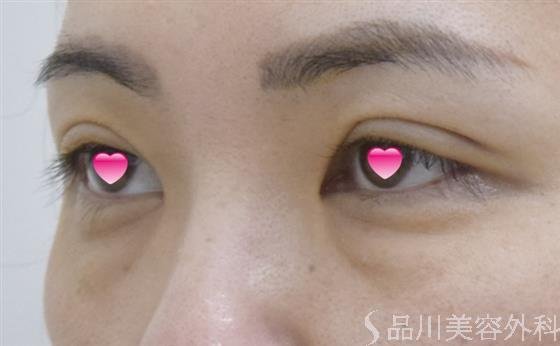 症例NO.52152のBEFORE写真