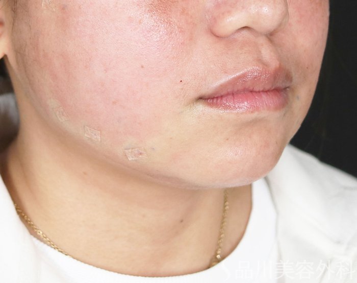 症例NO.73454のAFTER写真