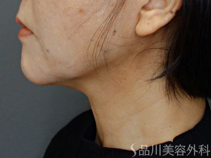 症例NO.74629のBEFORE写真