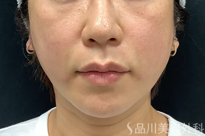 症例NO.73312のAFTER写真