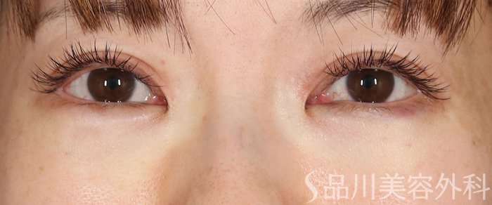 症例NO.72172のAFTER写真