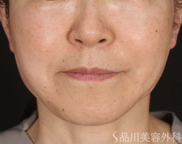 症例NO.73516のAFTER写真